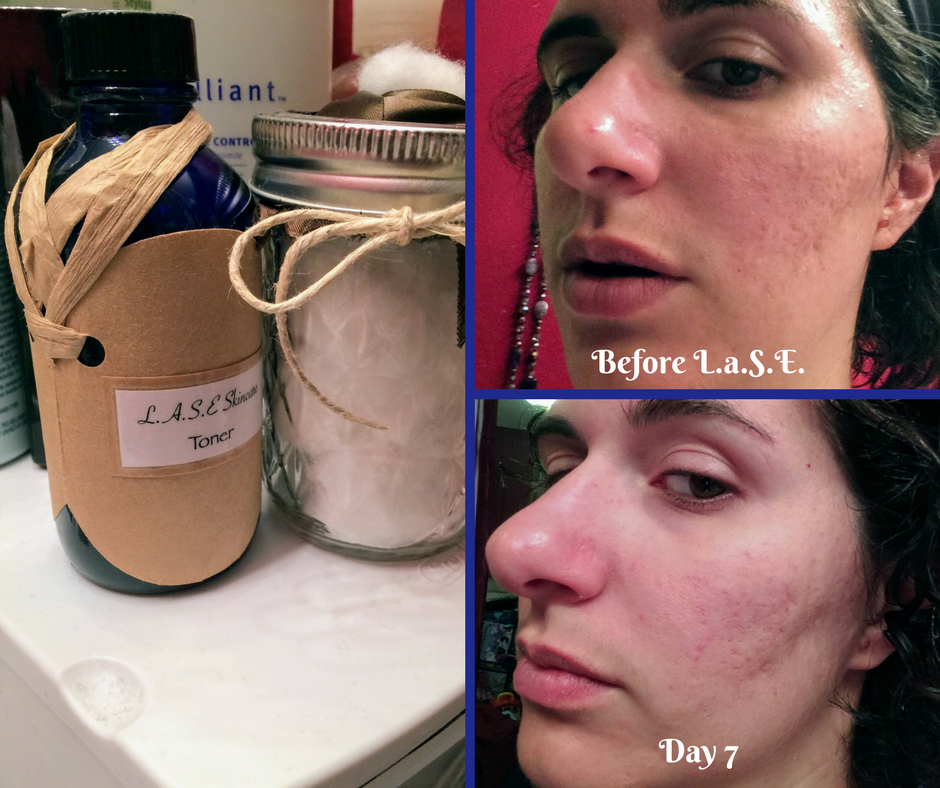 L.a.S.E Skincare