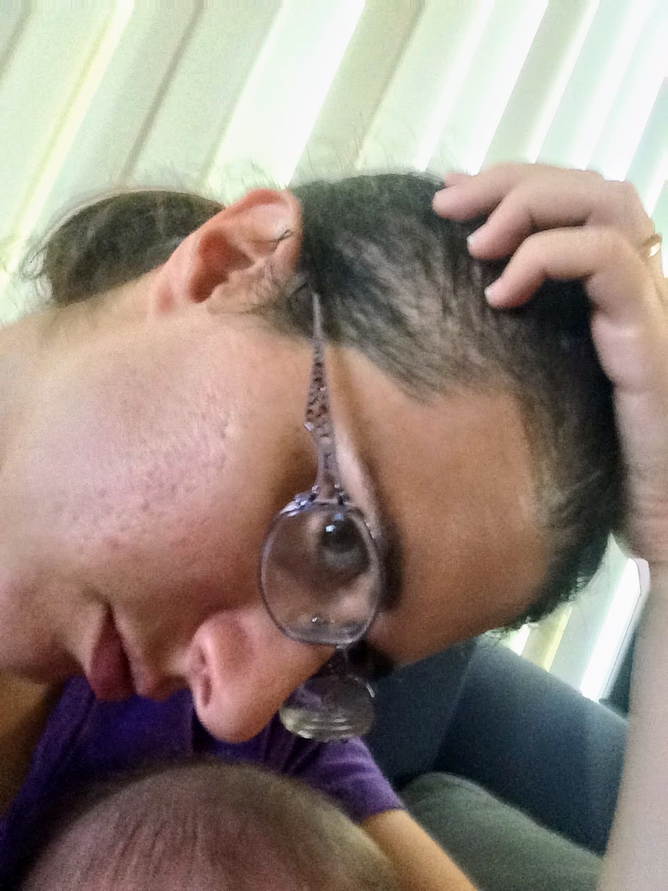 Postpartum Hairloss